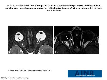 A, Axial fat-saturated T2WI through the orbits of a patient with right MGDA demonstrates a funnel-shaped morphologic pattern of the optic disc (white arrow)