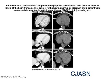 Representative transaxial thin computed tomography (CT) sections at mid, mid-low, and low levels of the heart from a control subject (left) showing normal.