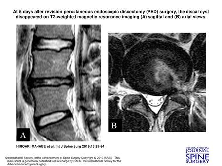 At 5 days after revision percutaneous endoscopic discectomy (PED) surgery, the discal cyst disappeared on T2-weighted magnetic resonance imaging (A) sagittal.