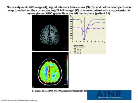 Source dynamic MR image (A), signal intensity time curves (S) (B), and color-coded perfusion map (overlaid on the corresponding FLAIR image) (C) of a male.