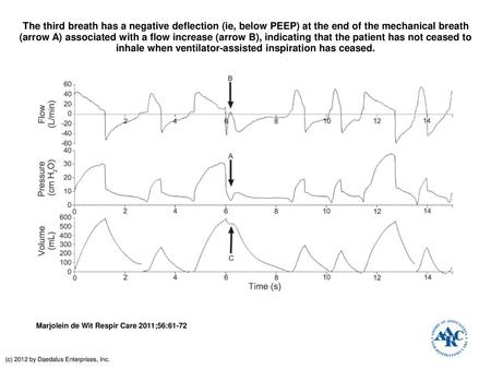 The third breath has a negative deflection (ie, below PEEP) at the end of the mechanical breath (arrow A) associated with a flow increase (arrow B), indicating.