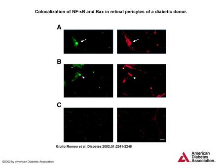 Colocalization of NF-κB and Bax in retinal pericytes of a diabetic donor. Colocalization of NF-κB and Bax in retinal pericytes of a diabetic donor. A trypsin.