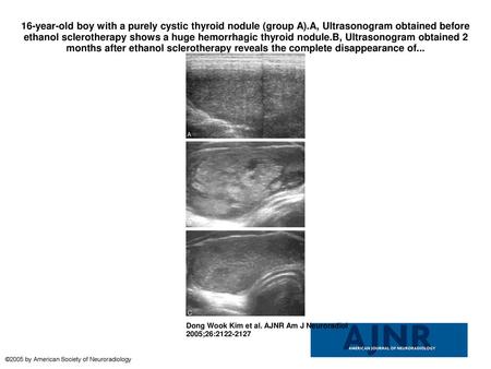 16-year-old boy with a purely cystic thyroid nodule (group A)