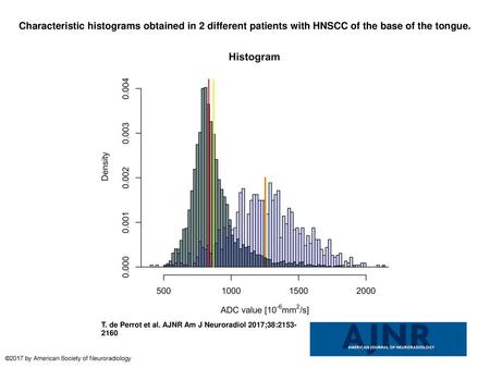 Characteristic histograms obtained in 2 different patients with HNSCC of the base of the tongue. Characteristic histograms obtained in 2 different patients.