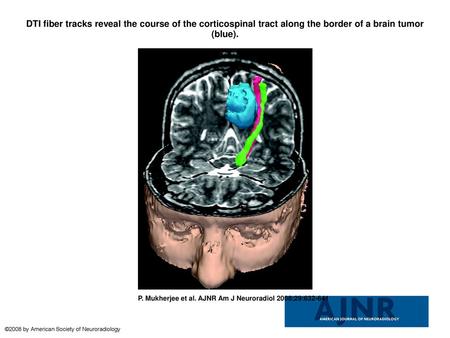 DTI fiber tracks reveal the course of the corticospinal tract along the border of a brain tumor (blue). DTI fiber tracks reveal the course of the corticospinal.