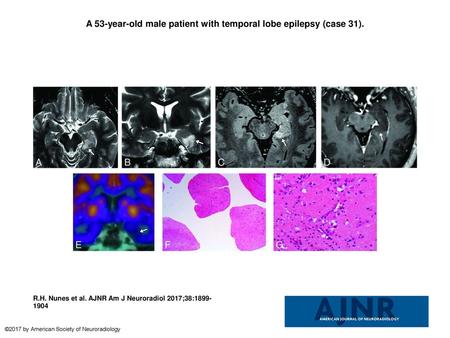 A 53-year-old male patient with temporal lobe epilepsy (case 31).