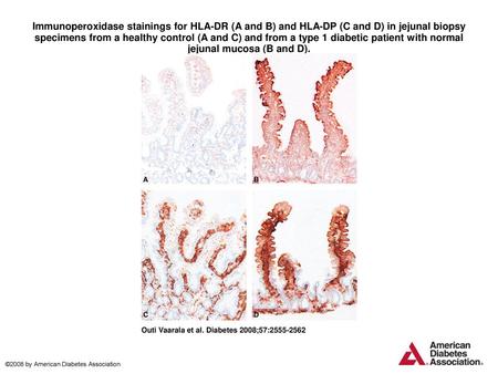 Immunoperoxidase stainings for HLA-DR (A and B) and HLA-DP (C and D) in jejunal biopsy specimens from a healthy control (A and C) and from a type 1 diabetic.