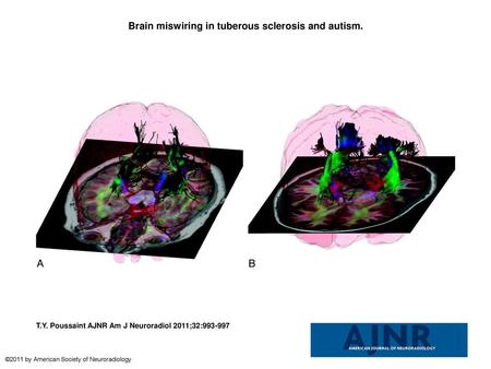 Brain miswiring in tuberous sclerosis and autism.