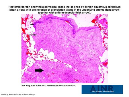 Photomicrograph showing a polypoidal mass that is lined by benign squamous epithelium (short arrow) with proliferation of granulation tissue in the underlying.