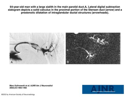 64-year-old man with a large sialith in the main parotid duct