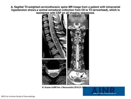 A, Sagittal T2-weighted cervicothoracic spine MR image from a patient with intracranial hypotension shows a ventral extradural collection from C6 to T2.