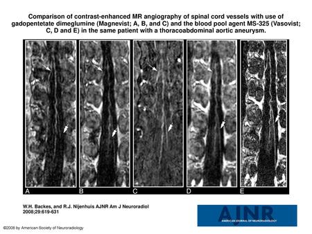 Comparison of contrast-enhanced MR angiography of spinal cord vessels with use of gadopentetate dimeglumine (Magnevist; A, B, and C) and the blood pool.