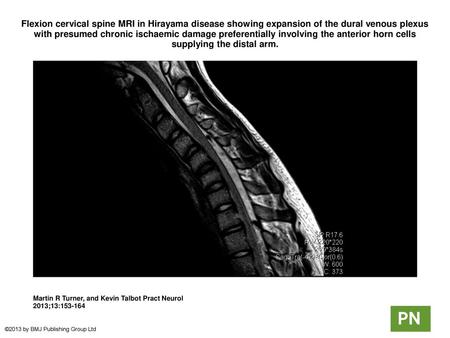 Flexion cervical spine MRI in Hirayama disease showing expansion of the dural venous plexus with presumed chronic ischaemic damage preferentially involving.