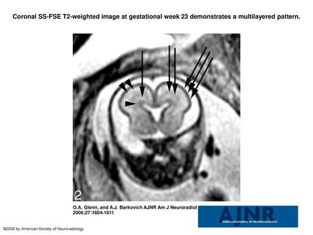 Coronal SS-FSE T2-weighted image at gestational week 23 demonstrates a multilayered pattern. Coronal SS-FSE T2-weighted image at gestational week 23 demonstrates.