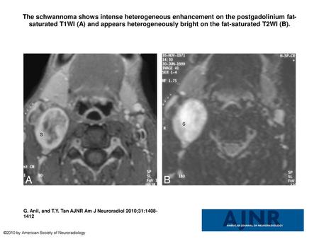 The schwannoma shows intense heterogeneous enhancement on the postgadolinium fat-saturated T1WI (A) and appears heterogeneously bright on the fat-saturated.