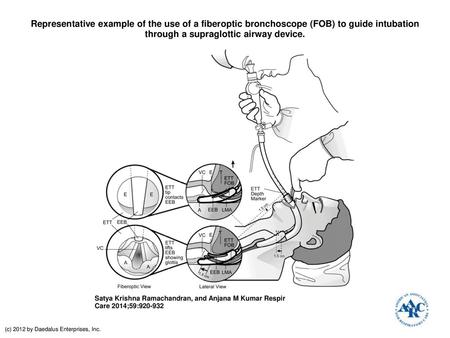 Representative example of the use of a fiberoptic bronchoscope (FOB) to guide intubation through a supraglottic airway device. Representative example of.