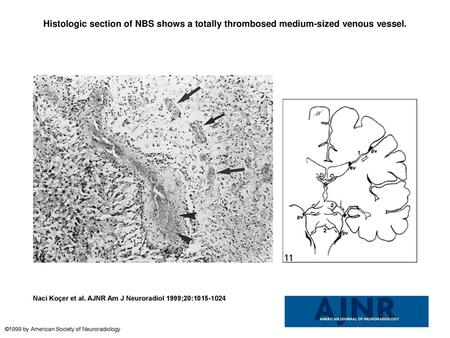 Histologic section of NBS shows a totally thrombosed medium-sized venous vessel. Histologic section of NBS shows a totally thrombosed medium-sized venous.