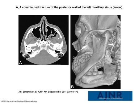 A, A comminuted fracture of the posterior wall of the left maxillary sinus (arrow). A, A comminuted fracture of the posterior wall of the left maxillary.