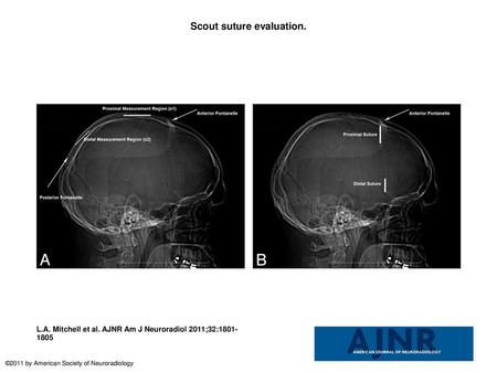 Scout suture evaluation.