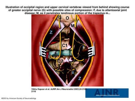 Illustration of occipital region and upper cervical vertebrae viewed from behind showing course of greater occipital nerve (G) with possible sites of compression: