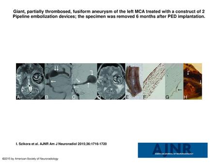 Giant, partially thrombosed, fusiform aneurysm of the left MCA treated with a construct of 2 Pipeline embolization devices; the specimen was removed 6.