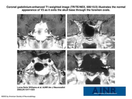 Coronal gadolinium-enhanced T1-weighted image (TR/TE/NEX, 500/15/2) illustrates the normal appearance of V3 as it exits the skull base through the foramen.