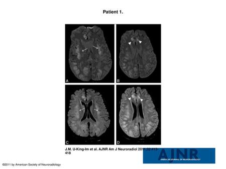 Patient 1. Patient 1. A 24-year-old woman with complicated (cardiac failure, pulmonary edema, chest infection, sternal wound sepsis, and venous thrombosis)