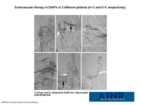 Endovascular therapy in DAVFs in 2 different patients (A−C and D−F, respectively). Endovascular therapy in DAVFs in 2 different patients (A−C and D−F,