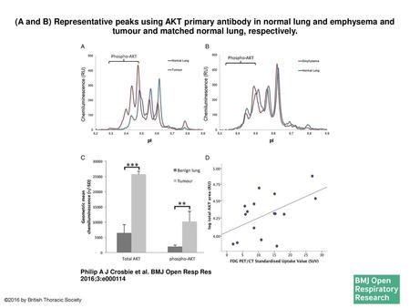 (A and B) Representative peaks using AKT primary antibody in normal lung and emphysema and tumour and matched normal lung, respectively. (A and B) Representative.