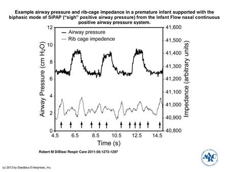 Example airway pressure and rib-cage impedance in a premature infant supported with the biphasic mode of SiPAP (“sigh” positive airway pressure) from the.