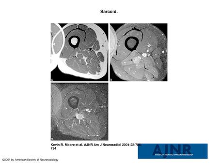 Sarcoid. Sarcoid. A, Axial T1-weighted spin-echo unenhanced image (600/9/2), obtained through the proximal right thigh, reveals an isointense (to muscle)