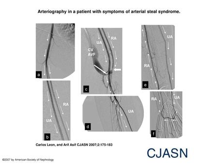 Arteriography in a patient with symptoms of arterial steal syndrome.