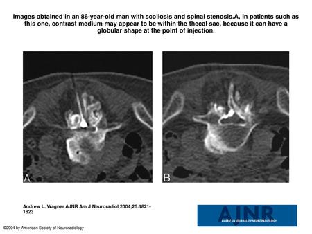 Images obtained in an 86-year-old man with scoliosis and spinal stenosis.A, In patients such as this one, contrast medium may appear to be within the thecal.