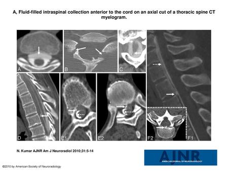 A, Fluid-filled intraspinal collection anterior to the cord on an axial cut of a thoracic spine CT myelogram. A, Fluid-filled intraspinal collection anterior.