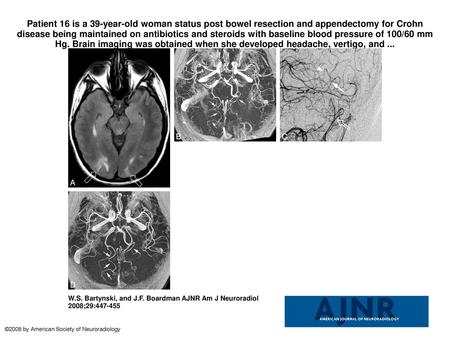 Patient 16 is a 39-year-old woman status post bowel resection and appendectomy for Crohn disease being maintained on antibiotics and steroids with baseline.