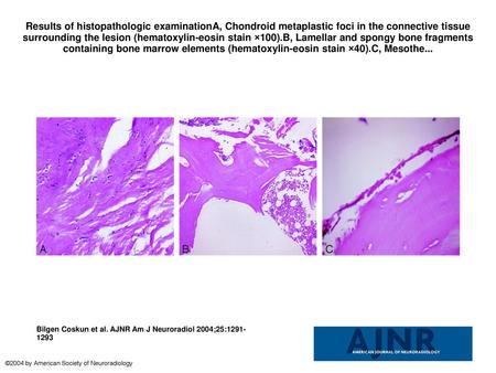 Results of histopathologic examinationA, Chondroid metaplastic foci in the connective tissue surrounding the lesion (hematoxylin-eosin stain ×100).B, Lamellar.