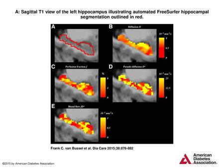 A: Sagittal T1 view of the left hippocampus illustrating automated FreeSurfer hippocampal segmentation outlined in red. A: Sagittal T1 view of the left.