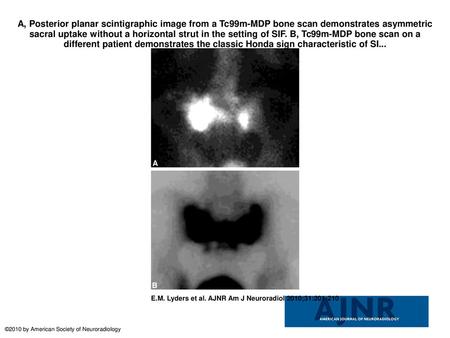 A, Posterior planar scintigraphic image from a Tc99m-MDP bone scan demonstrates asymmetric sacral uptake without a horizontal strut in the setting of SIF.