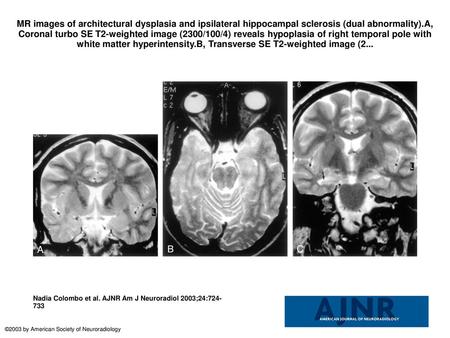 MR images of architectural dysplasia and ipsilateral hippocampal sclerosis (dual abnormality).A, Coronal turbo SE T2-weighted image (2300/100/4) reveals.