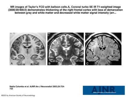 MR images of Taylor’s FCD with balloon cells