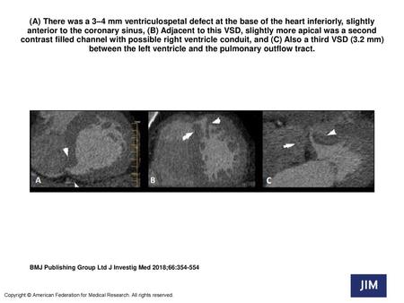 (A) There was a 3–4 mm ventriculospetal defect at the base of the heart inferiorly, slightly anterior to the coronary sinus, (B) Adjacent to this VSD,