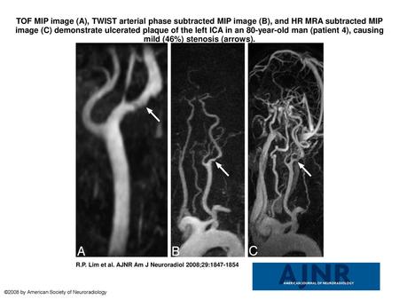 TOF MIP image (A), TWIST arterial phase subtracted MIP image (B), and HR MRA subtracted MIP image (C) demonstrate ulcerated plaque of the left ICA in an.