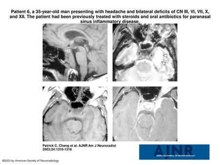 Patient 6, a 35-year-old man presenting with headache and bilateral deficits of CN III, VI, VII, X, and XII. The patient had been previously treated with.