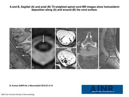 A and B, Sagittal (A) and axial (B) T2-weighted spinal cord MR images show hemosiderin deposition along (A) and around (B) the cord surface. A and B, Sagittal.