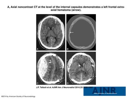 A, Axial noncontrast CT at the level of the internal capsules demonstrates a left frontal extra-axial hematoma (arrow). A, Axial noncontrast CT at the.