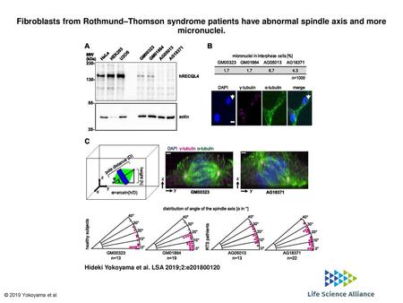 Fibroblasts from Rothmund–Thomson syndrome patients have abnormal spindle axis and more micronuclei. Fibroblasts from Rothmund–Thomson syndrome patients.