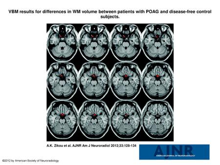 VBM results for differences in WM volume between patients with POAG and disease-free control subjects. VBM results for differences in WM volume between.