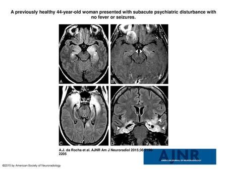 A previously healthy 44-year-old woman presented with subacute psychiatric disturbance with no fever or seizures. A previously healthy 44-year-old woman.