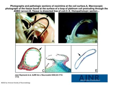 Photographs and pathologic sections of neointima at the coil surface