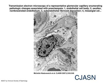 Transmission electron microscopy of a representative glomerular capillary enumerating pathologic changes associated with preeclampsia: 1, endothelial cell.